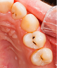 CAVITIES / TOOTH DECAY