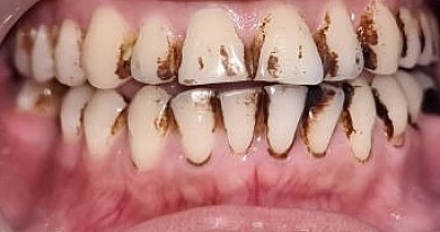STAINING OF TEETH