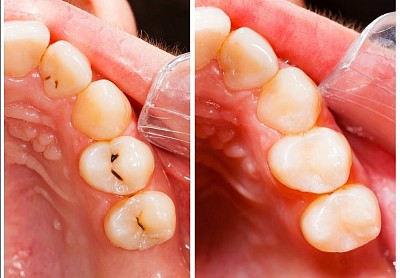 COMPOSITE FILLING