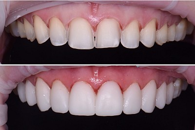 VENEERS
