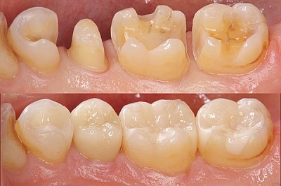DENTAL INLAY / ONLAY