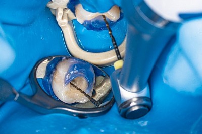 ROOT CANAL TREATMENT