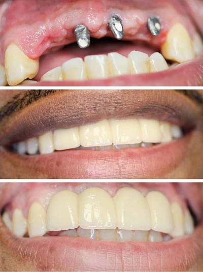 IMPLANTS