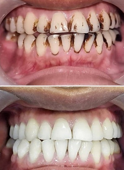 PROFESSIONAL DENTAL CLEANING