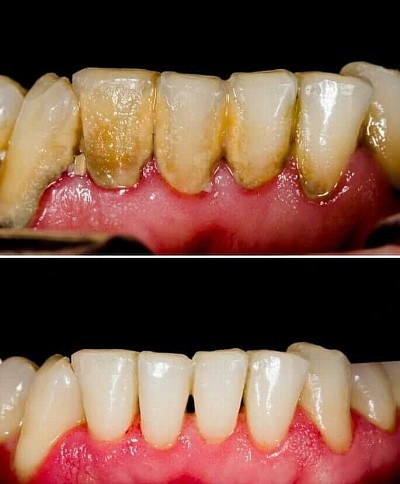 GUM DISEASE / FLAP SURGERY