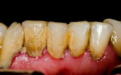 GUM DISEASE
