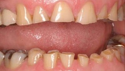 BRUXISM /TEETH GRINDING