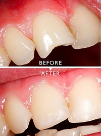 CRACKED/ CHIPPED TOOTH