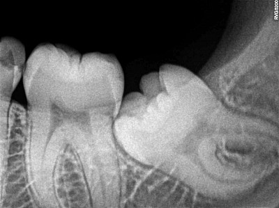 IMPACTED TOOTH