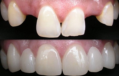TOOTH BRIDGES