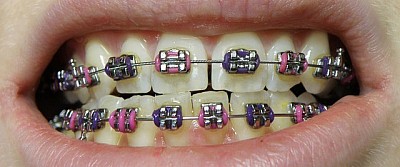 BRACES
